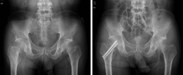 다발성 핀 고정술 이미지