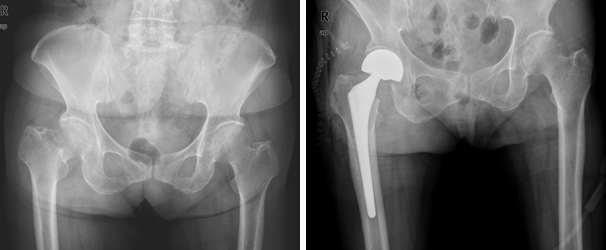 인공 관절 반치환술 이미지