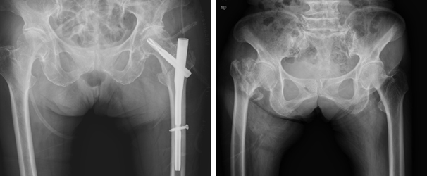 인공관절 반치환술 이미지