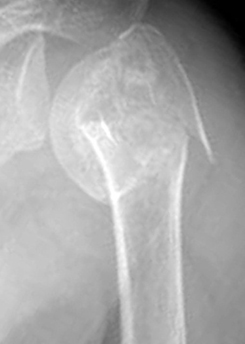 위 상완골의 골절로 3개 부분이 어긋나 있는 3분 골절