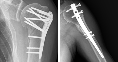 위 상완골의 골절로 3개 부분이 어긋나 있는 3분 골절
