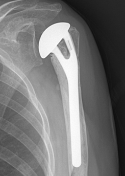 노인에서 4분 골절이 발생되면 부러진 부분을인공 관절로 치환하는 수술이 적응이 되기도 합니다.