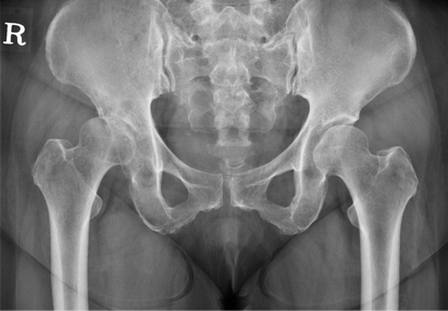 고관절 주위 절골술 이미지