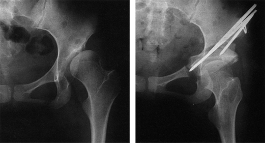 고관절 주위 절골술 이미지