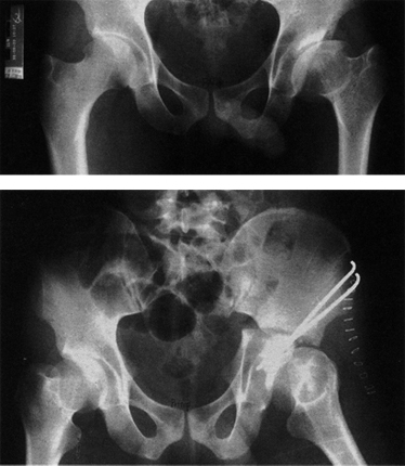 고관절 주위 절골술 이미지