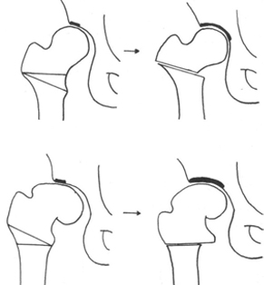 고관절 주위 절골술 이미지