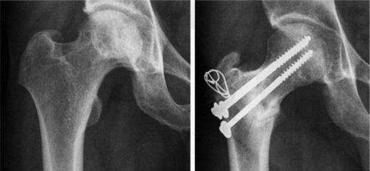 고관절 주위 절골술 이미지