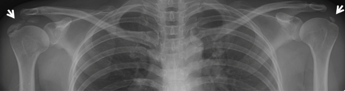 석회화건염 이미지