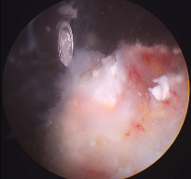 석회화건염 이미지