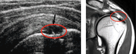 회전근개파열 이미지
