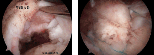 회전근개파열 이미지