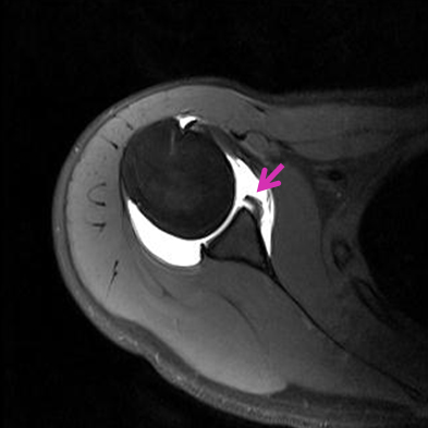 MRI 사진에서는 파열된 전방 관절순을 보입니다