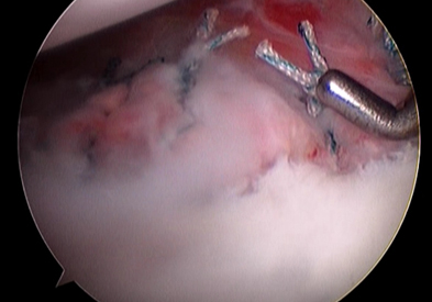 파열된 전방 관절순을 관절경하 봉합술을 시행
