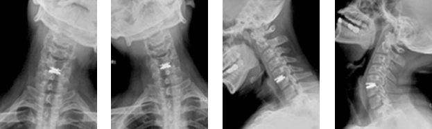 목인공디스크치환술 수술 후
