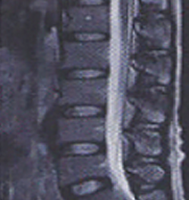 추간판 정상 이미지