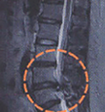 추간판 정상 이미지