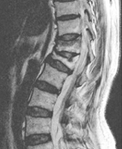 척추 전방전위증 이미지