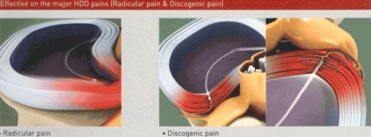 L'DISQ치료술  이미지