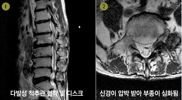 허리 신경성형술  이미지