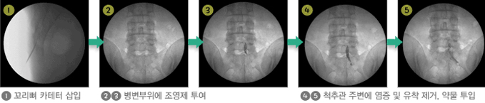 허리 신경성형술  이미지