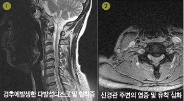 목 신경성형술  이미지