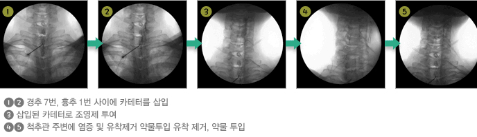 목 신경성형술  이미지