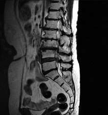 척추관협착증 이미지