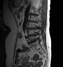 척추관협착증 이미지